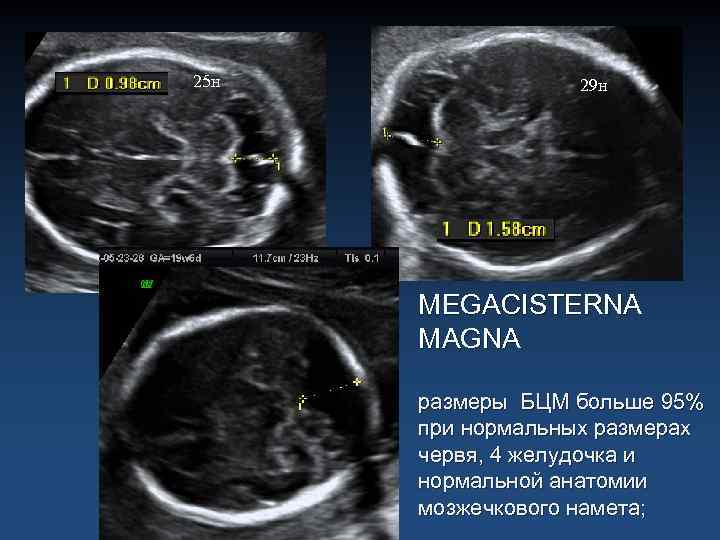 25 н 29 н MEGACISTERNA MAGNA размеры БЦМ больше 95% при нормальных размерах червя,