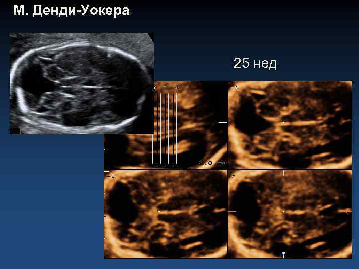 М. Денди-Уокера 25 нед 