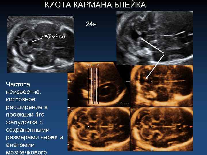 КИСТА КАРМАНА БЛЕЙКА 24 н 4 v(8 х6 мм) Частота неизвестна. кистозное расширение в
