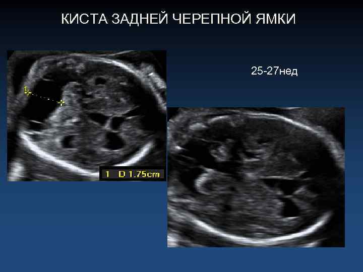 КИСТА ЗАДНЕЙ ЧЕРЕПНОЙ ЯМКИ 25 -27 нед 