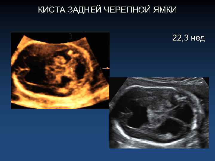 КИСТА ЗАДНЕЙ ЧЕРЕПНОЙ ЯМКИ 22, 3 нед 