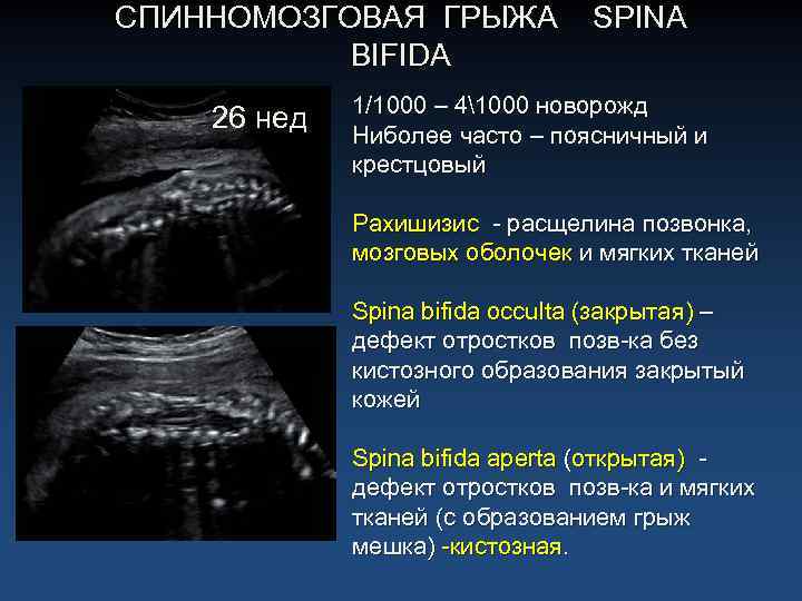 Можно увидеть грыжу на узи. Спинномозговая грыжа на УЗИ. Спинномозговая грыжа spina Bifida.