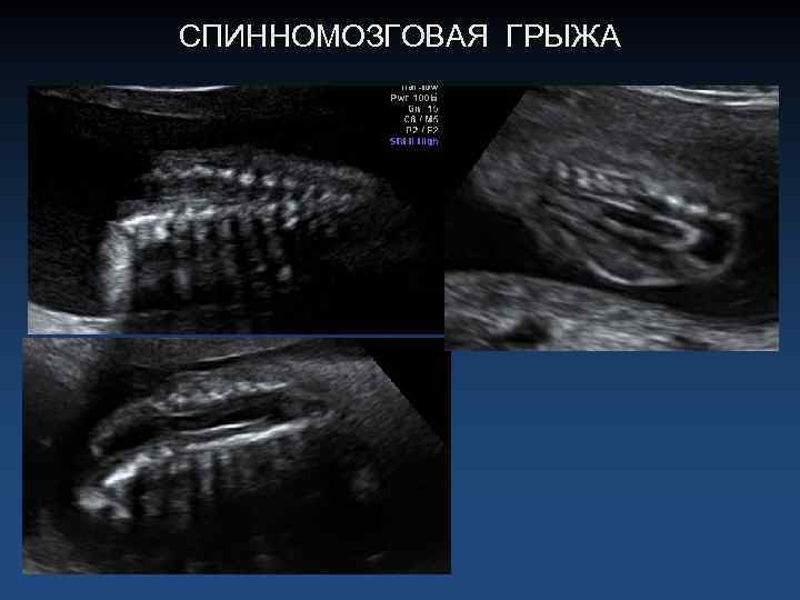 СПИННОМОЗГОВАЯ ГРЫЖА 