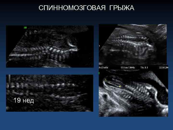 СПИННОМОЗГОВАЯ ГРЫЖА 19 нед 