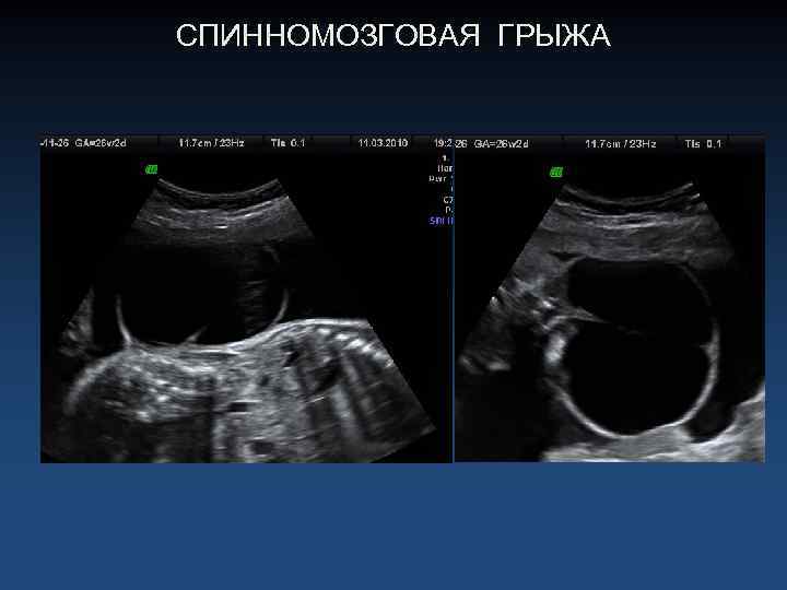 СПИННОМОЗГОВАЯ ГРЫЖА 