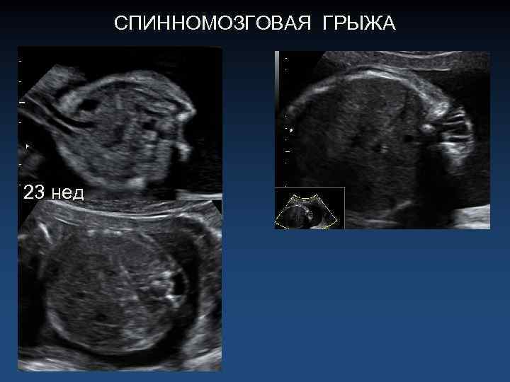 СПИННОМОЗГОВАЯ ГРЫЖА 23 нед 