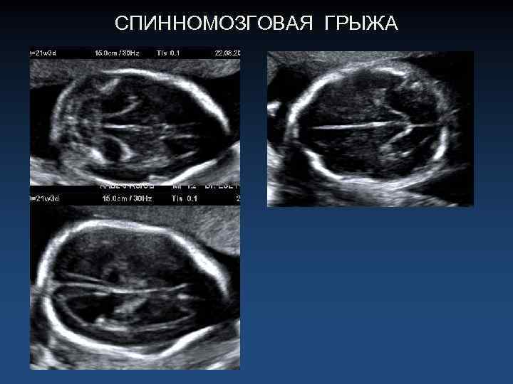 СПИННОМОЗГОВАЯ ГРЫЖА 