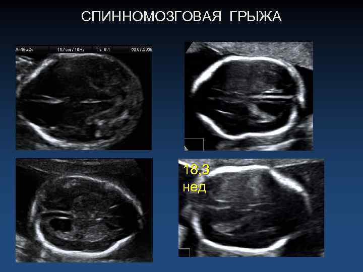 СПИННОМОЗГОВАЯ ГРЫЖА 18, 3 нед 