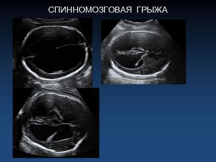 СПИННОМОЗГОВАЯ ГРЫЖА 
