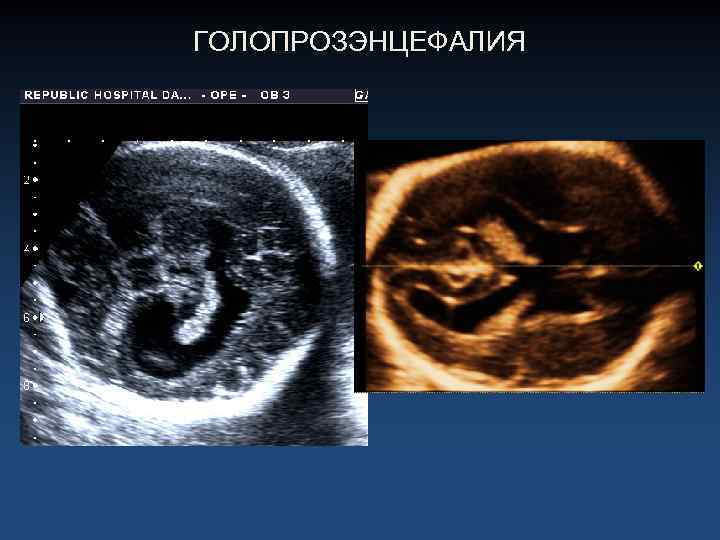 ГОЛОПРОЗЭНЦЕФАЛИЯ 