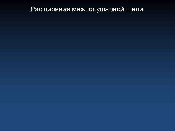Расширение межполушарной щели 