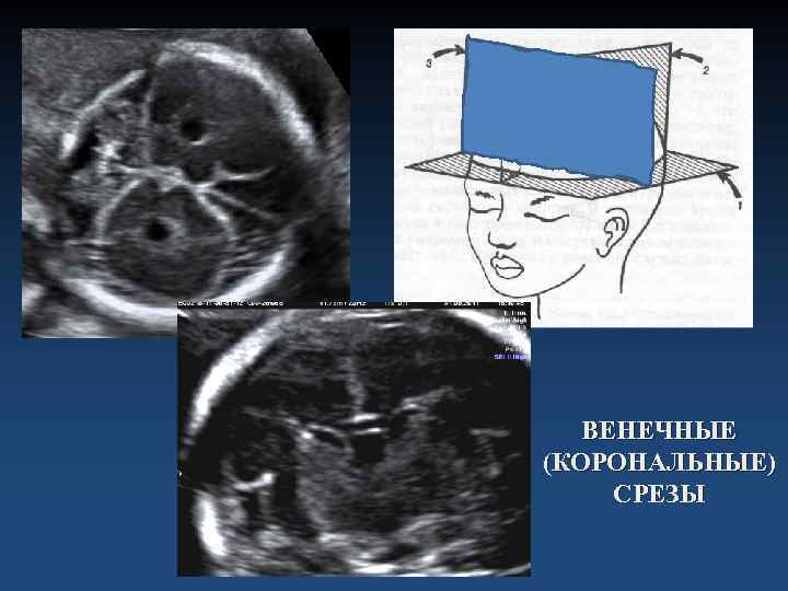  ВЕНЕЧНЫЕ (КОРОНАЛЬНЫЕ) СРЕЗЫ 