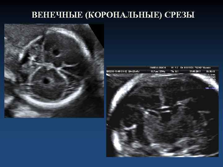 ВЕНЕЧНЫЕ (КОРОНАЛЬНЫЕ) СРЕЗЫ 