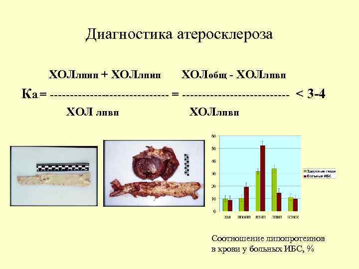 Диагностика атеросклероза ХОЛлпнп + ХОЛлпнп ХОЛобщ - ХОЛлпвп Ка = --------------- = -------------- <