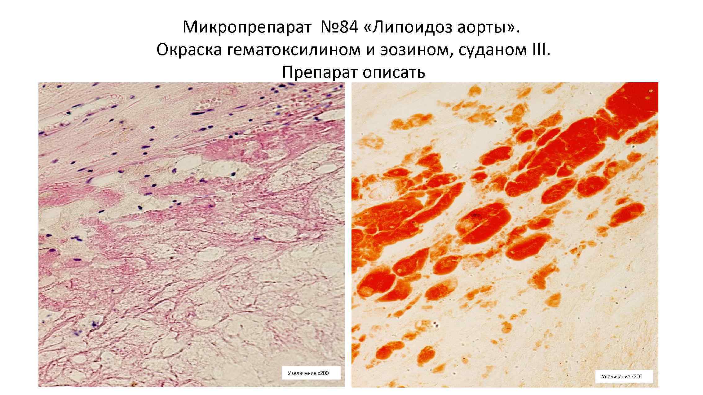 Увеличение х. Окраска Суданом III-гематоксилином. Атеросклероз аорты Судан 3. Окраска Суданом 3 патанатомия. Окраска Суданом 3 гистология.