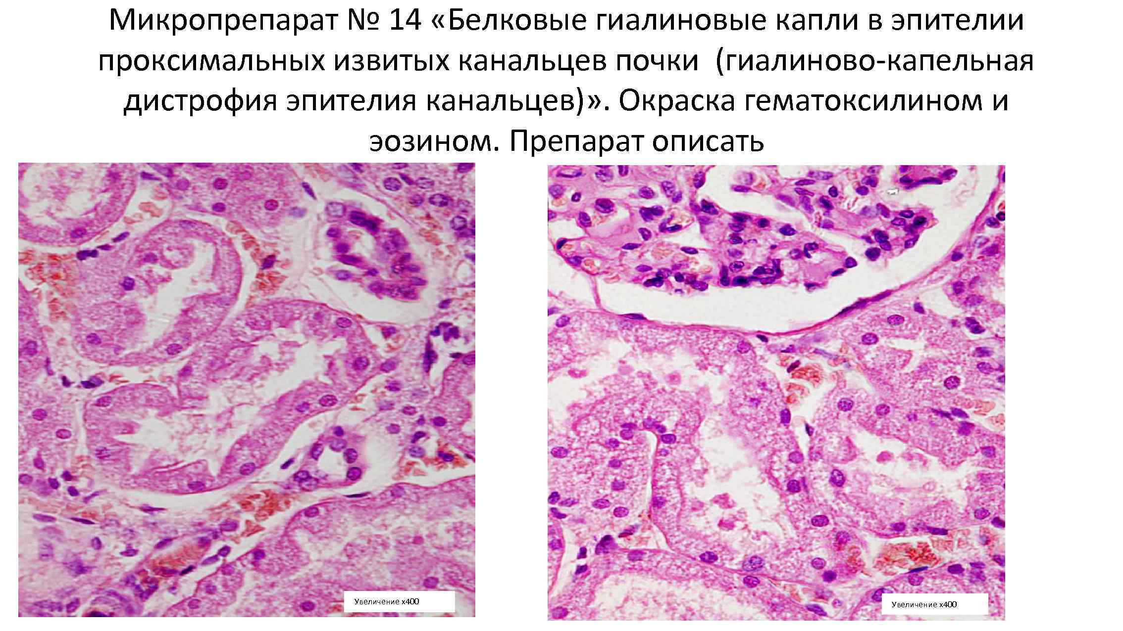 Описание микропрепарата. Гиалиново капельная дистрофия микропрепарат. Гиалиново-капельная дистрофия эпителия канальцев почки. Гиалиново-капельная дистрофия почек микропрепарат. Гиалиново-капельная дистрофия почек макропрепарат.