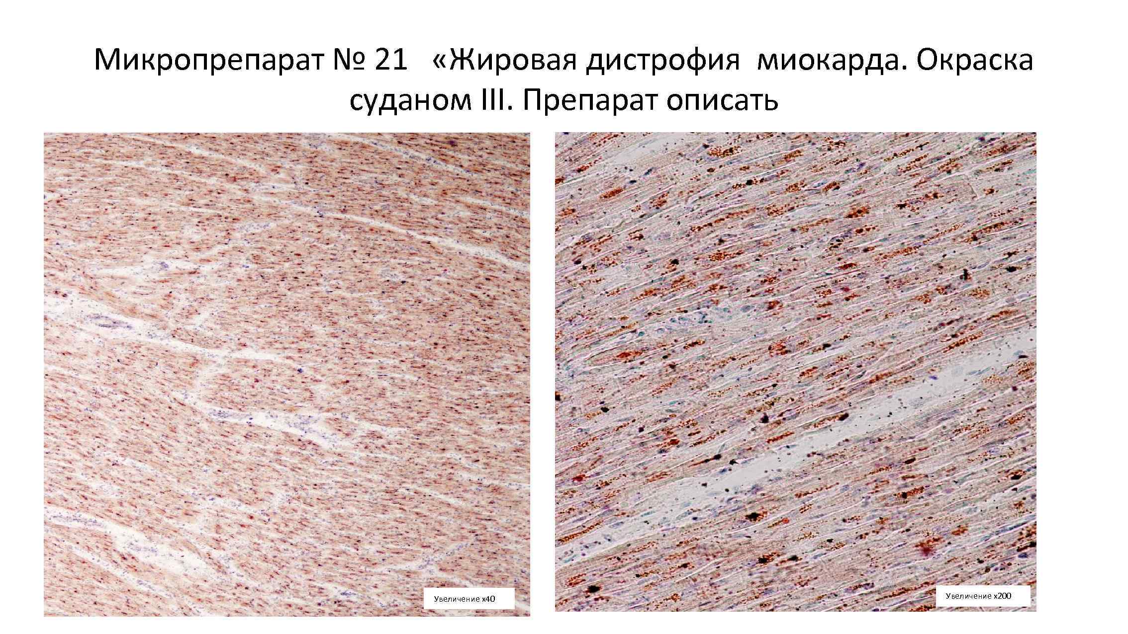 Жировая дистрофия миокарда. Жировая дистрофия миокарда окраска Суданом. Жировая дистрофия миокарда микропрепарат. Микропрепарат жировая дистрофия миокарда Тигровое сердце. Жировая дистрофия миокарда Судан 3.