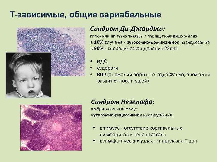 Т-зависимые, общие вариабельные Синдром Ди-Джорджи: гипо- или аплазия тимуса и паращитовидных желез в 10%