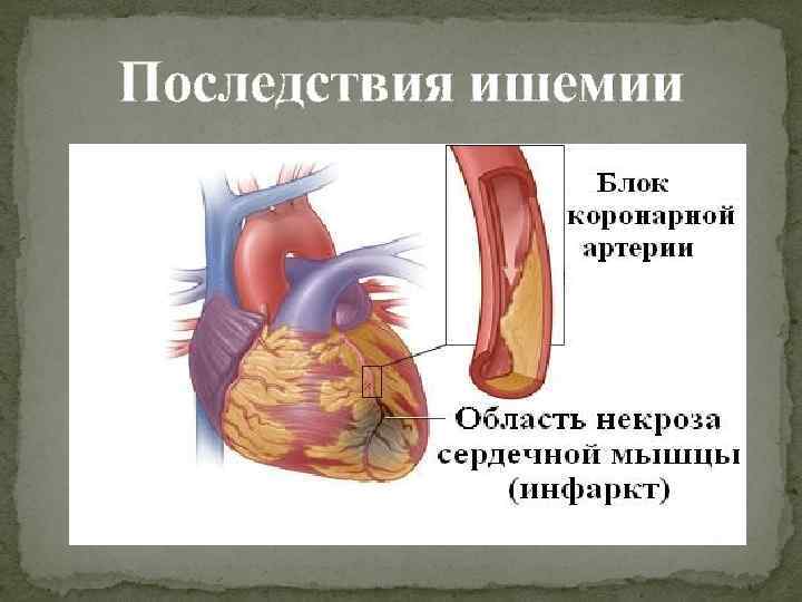 Последствия ишемии 