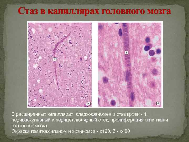 Стаз в капиллярах головного мозга В расширенных капиллярах сладж-феномен и стаз крови - 1,