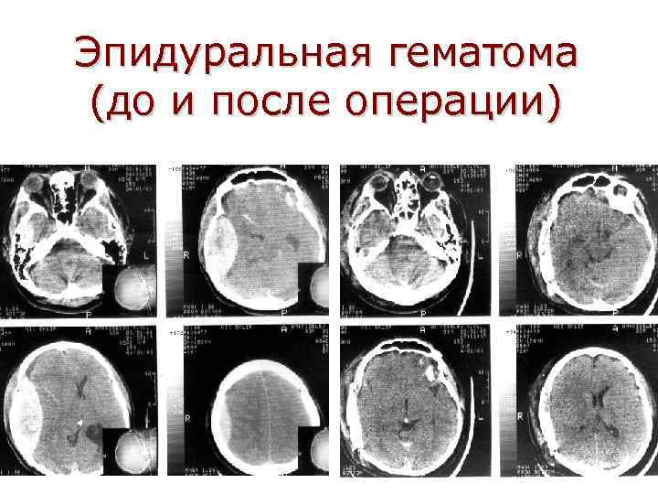Эпидуральная гематома (до и после операции) 