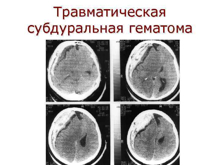 Травматическая субдуральная гематома 