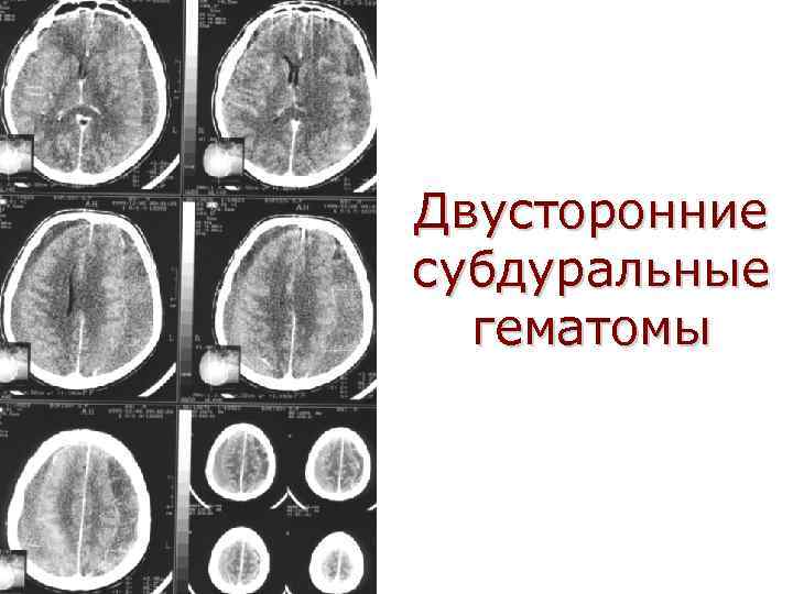 Двусторонние субдуральные гематомы 