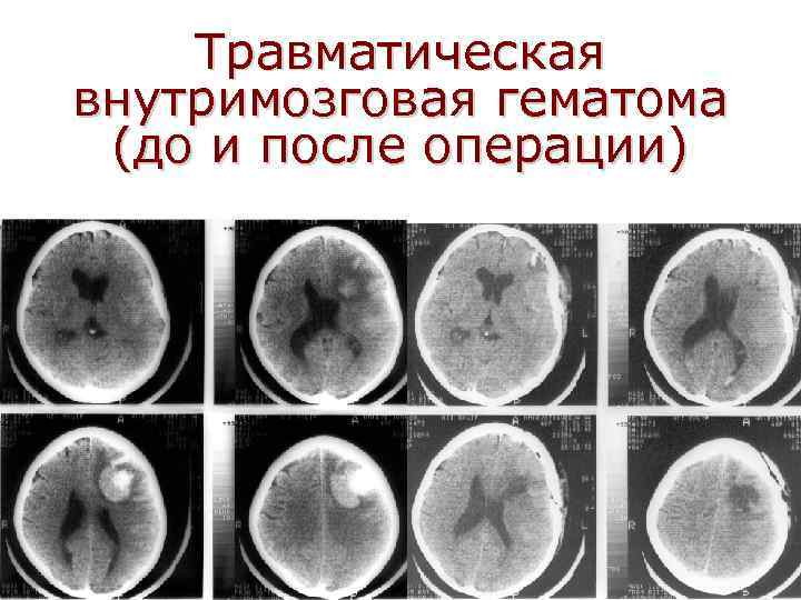 Травматическая внутримозговая гематома (до и после операции) 