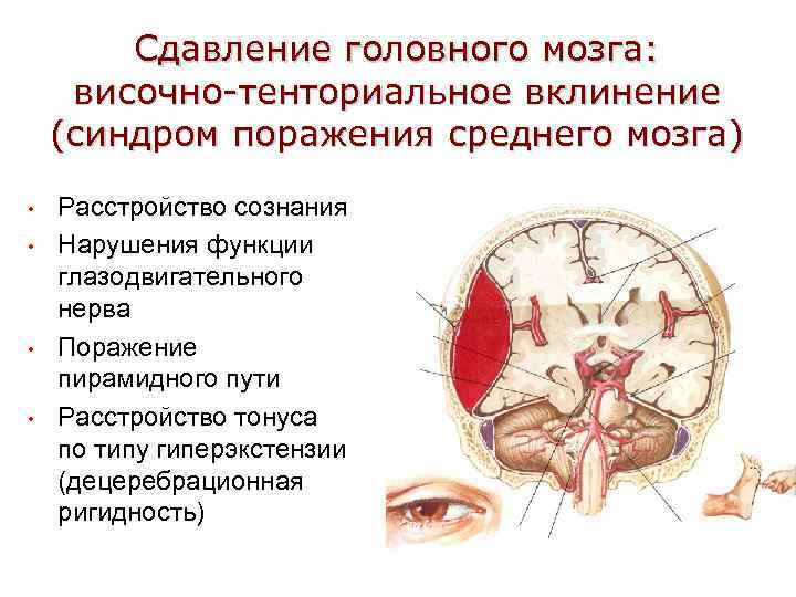 Сдавление головного мозга: височно-тенториальное вклинение (синдром поражения среднего мозга) • • Расстройство сознания Нарушения