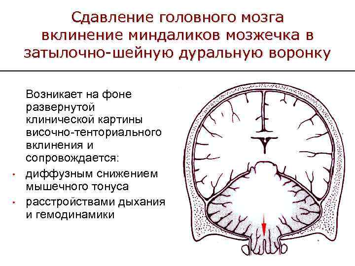 Сдавление головного мозга вклинение миндаликов мозжечка в затылочно-шейную дуральную воронку • • Возникает на