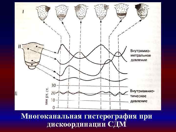 Многоканальная гистерография при дискоординации СДМ 