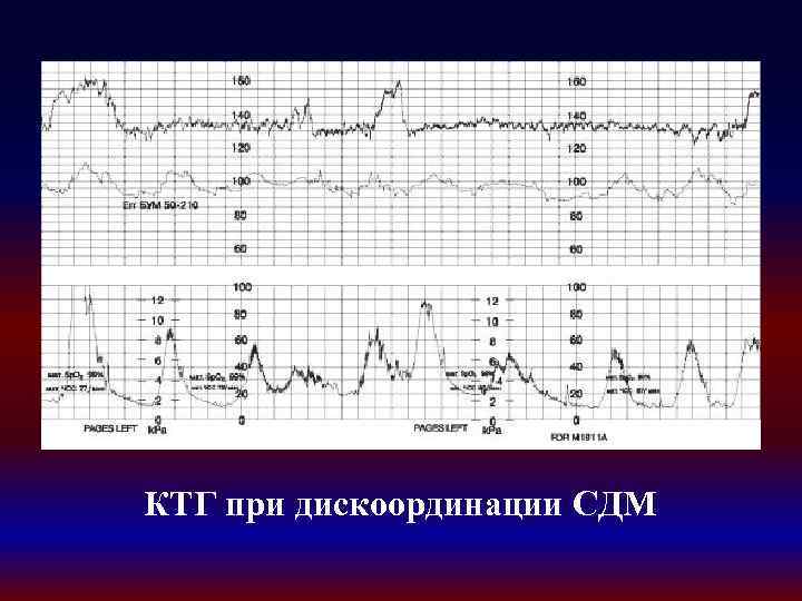 КТГ при дискоординации СДМ 