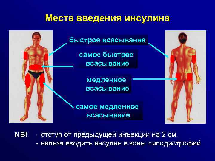 Места введения инсулина быстрое всасывание самое быстрое всасывание медленное всасывание самое медленное всасывание NB!