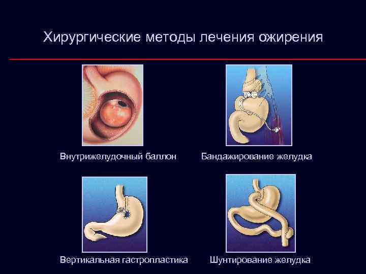 Хирургические методы лечения ожирения Внутрижелудочный баллон Вертикальная гастропластика Бандажирование желудка Шунтирование желудка 