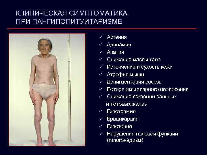 КЛИНИЧЕСКАЯ СИМПТОМАТИКА ПРИ ПАНГИПОПИТУИТАРИЗМЕ ü ü ü ü Астения Адинамия Апатия Снижение массы тела