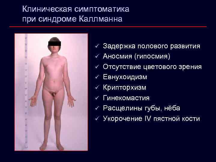 Клиническая симптоматика при синдроме Каллманна ü ü ü ü Задержка полового развития Аносмия (гипосмия)