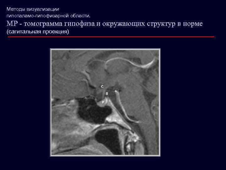 Методы визуализации гипоталамо-гипофизарной области. МР - томограмма гипофиза и окружающих структур в норме (сагитальная
