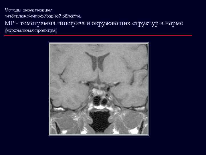 Методы визуализации гипоталамо-гипофизарной области. МР - томограмма гипофиза и окружающих структур в норме (корональная