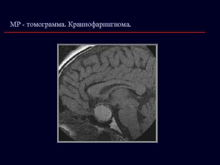 МР - томограмма. Краниофарингиома. 
