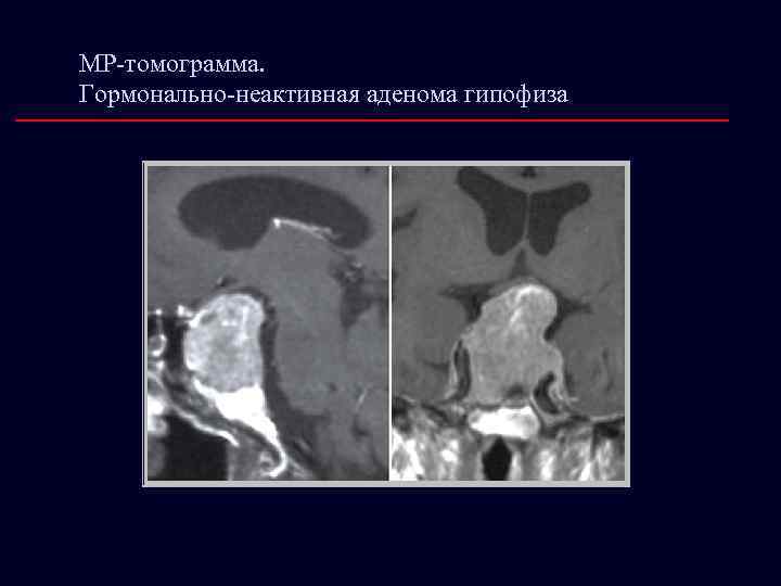 МР-томограмма. Гормонально-неактивная аденома гипофиза 