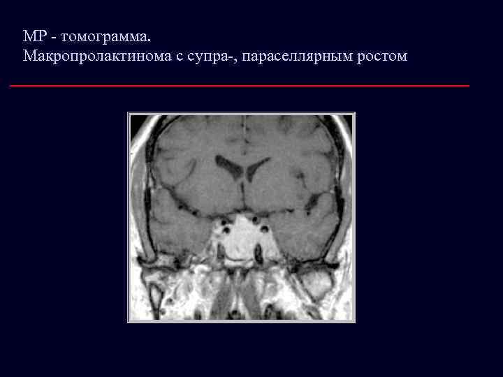 МР - томограмма. Макропролактинома с супра-, параселлярным ростом 