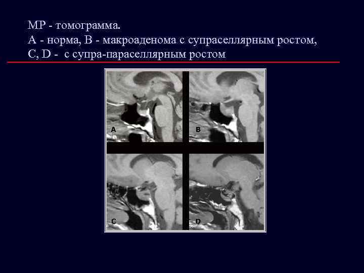 МР - томограмма. А - норма, В - макроаденома с супраселлярным ростом, С, D