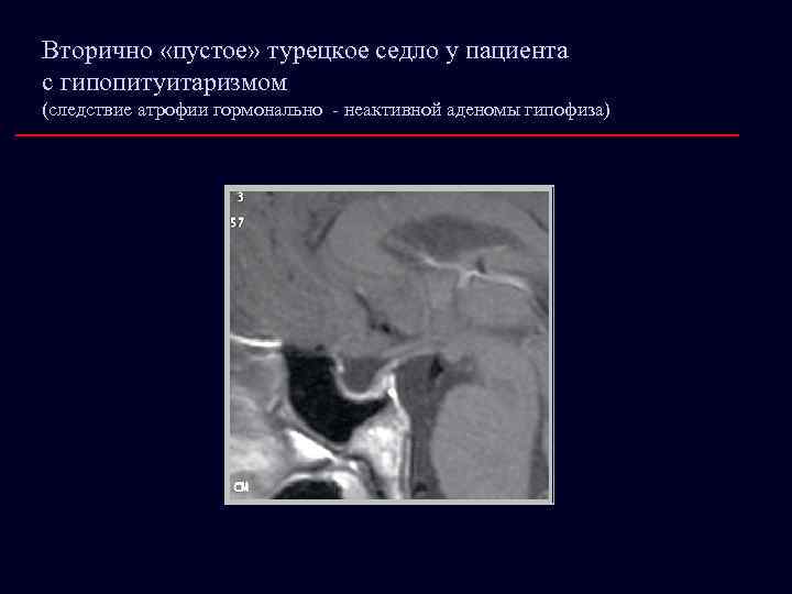 Вторично «пустое» турецкое седло у пациента с гипопитуитаризмом (следствие атрофии гормонально - неактивной аденомы