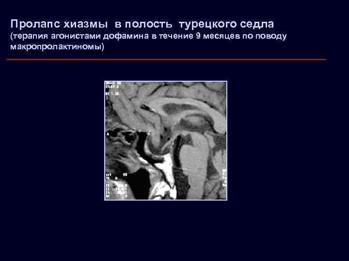 Пролапс хиазмы в полость турецкого седла (терапия агонистами дофамина в течение 9 месяцев по