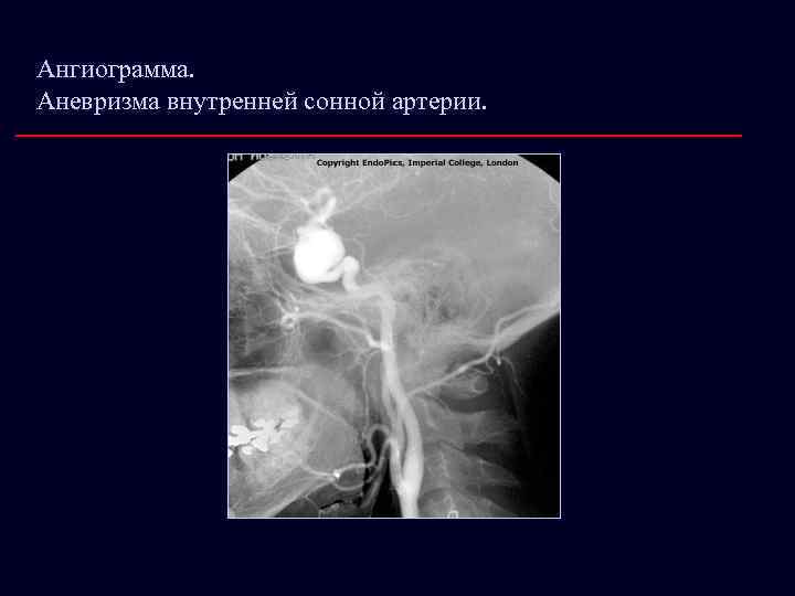 Ангиограмма. Аневризма внутренней сонной артерии. 