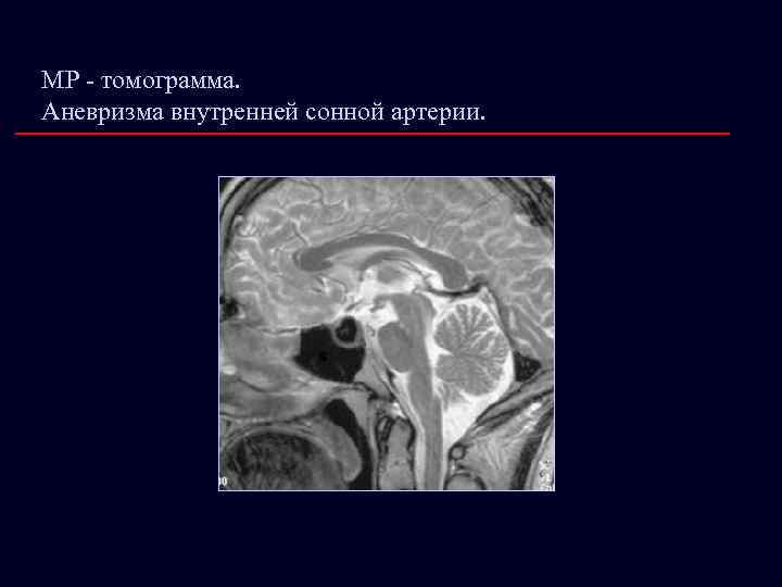 МР - томограмма. Аневризма внутренней сонной артерии. 