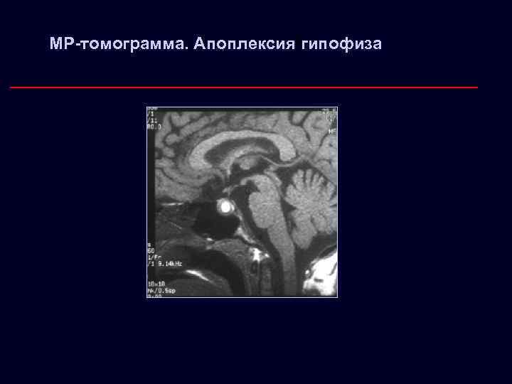 Апоплексия гипофиза МР-томограмма. Апоплексия гипофиза 
