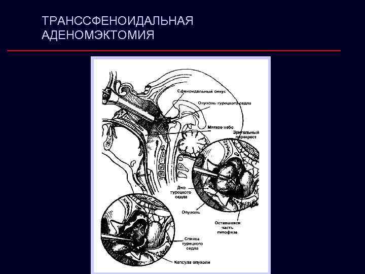 ТРАНССФЕНОИДАЛЬНАЯ АДЕНОМЭКТОМИЯ 