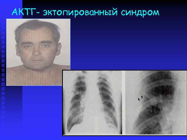 АКТГ- эктопированный синдром 