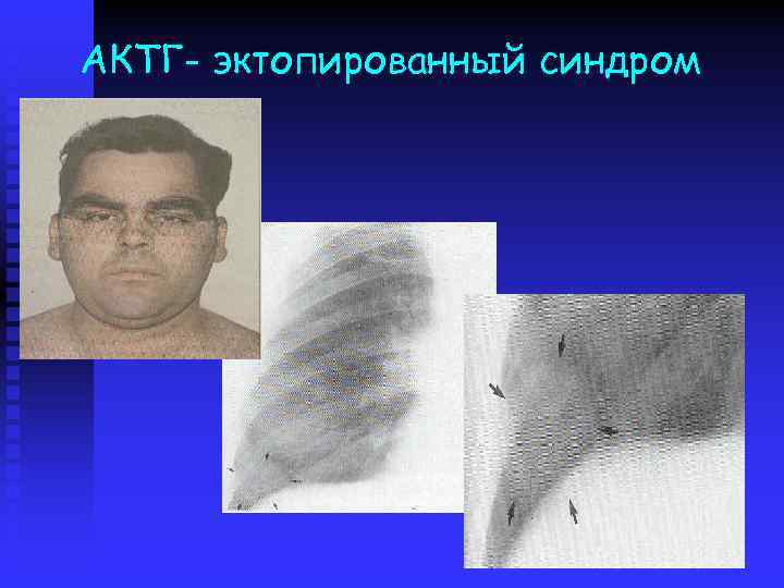 АКТГ- эктопированный синдром 